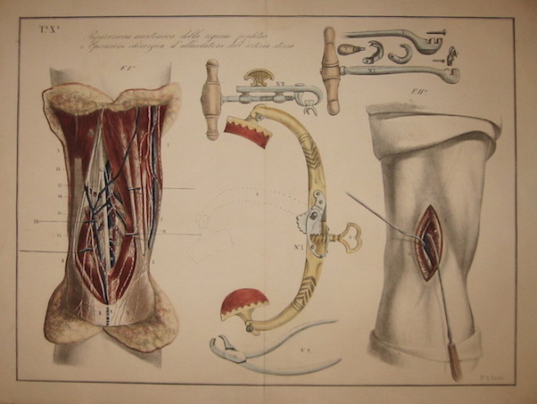 Sandri Antonio Tavola X. Preparazione anatomica della regione poplitea e operazione chirurgica d'allacciatura dell'arteria stessa 1854 Brescia 